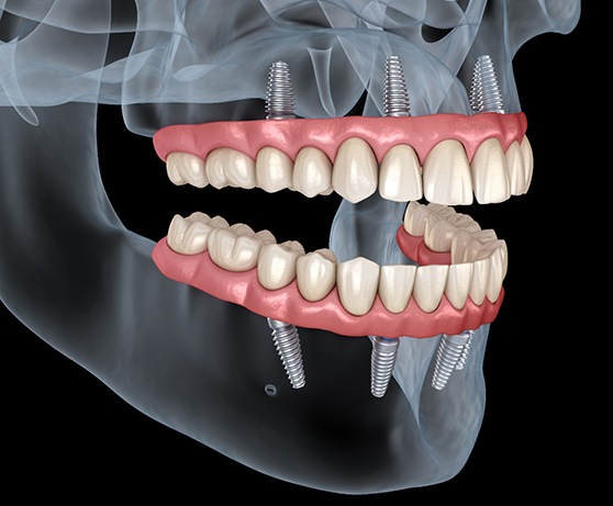 Illustration of All-on-4 dentures in Reston