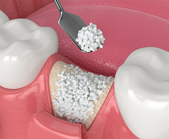 Animated dental bone graft