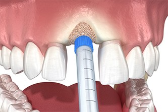Animated autogenous bone graft