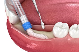 Animated allogenic bone graft