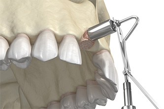 Animated synthetic bone graft