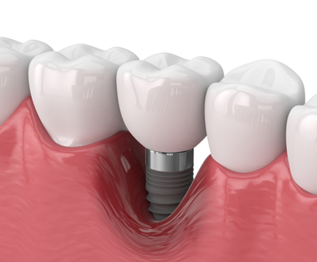 Illustration of bone loss around a failed dental implant in Reston