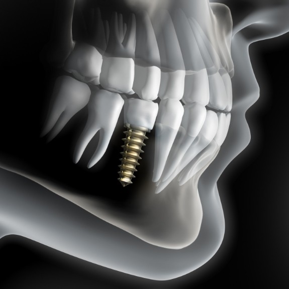 xray of dental implant