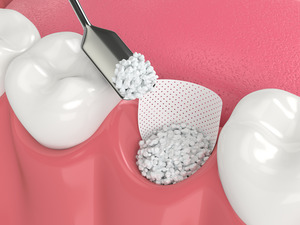 Illustration of bone grafting after a tooth extraction